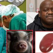 Hombre recibe un riñón de cerdo genéticamente modificado