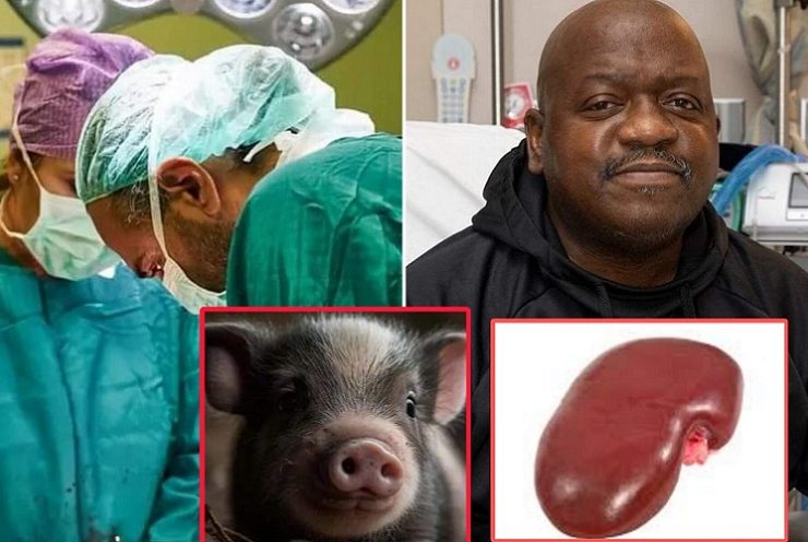 Hombre recibe un riñón de cerdo genéticamente modificado