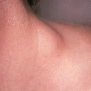 Linfoma de Hodgkin en Yucatán: Un Estudio Revelador