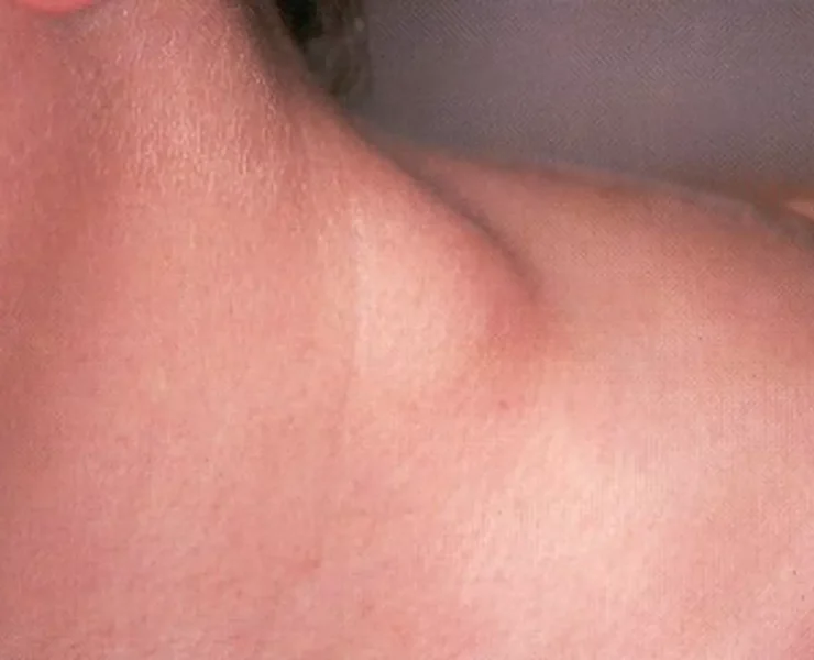 Linfoma de Hodgkin en Yucatán: Un Estudio Revelador