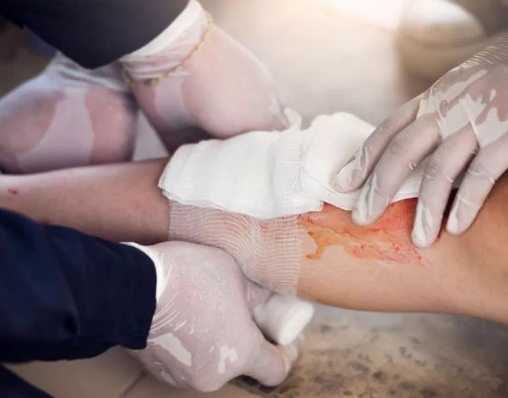 Se detectan casos de lepra en Yucatán y Campeche: conoce los detalles