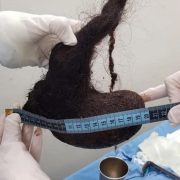 ¡Increíble pero cierto! Niña de 3 años es operada por extraño “Síndrome de Rapunzel” en Mérida