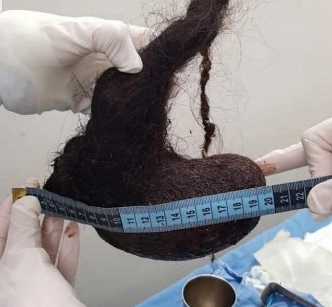 ¡Increíble pero cierto! Niña de 3 años es operada por extraño “Síndrome de Rapunzel” en Mérida