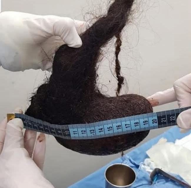 ¡Increíble pero cierto! Niña de 3 años es operada por extraño “Síndrome de Rapunzel” en Mérida