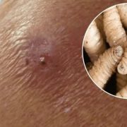 ¡Impactante! Séptimo caso de miasis por gusano barrenadoren pone en alerta a todos