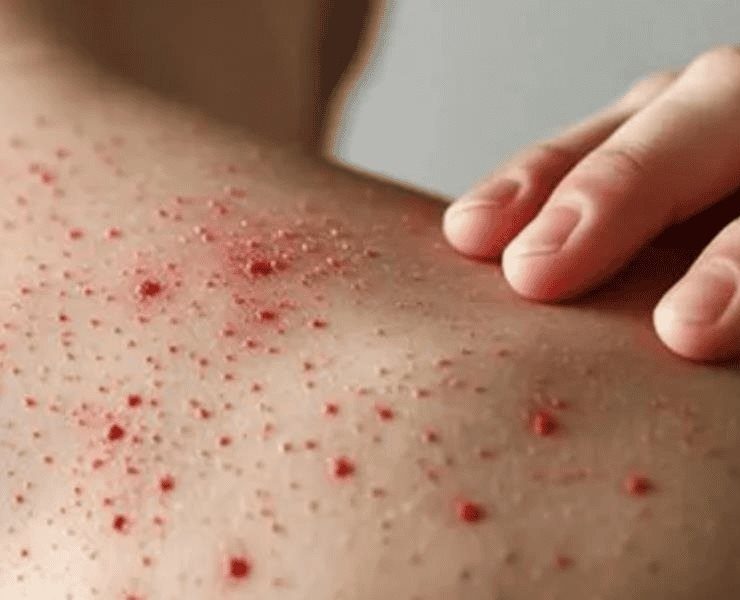 Alerta Sarampión: Yucatán registra siete casos confirmados