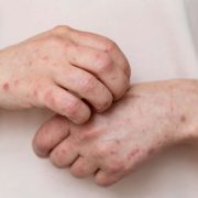 Alerta Sarampión: Yucatán registra 10 casos confirmados