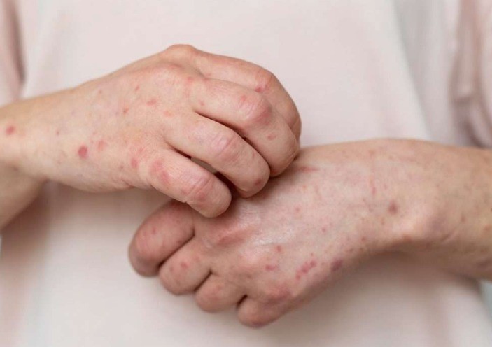 Alerta Sarampión: Yucatán registra 10 casos confirmados